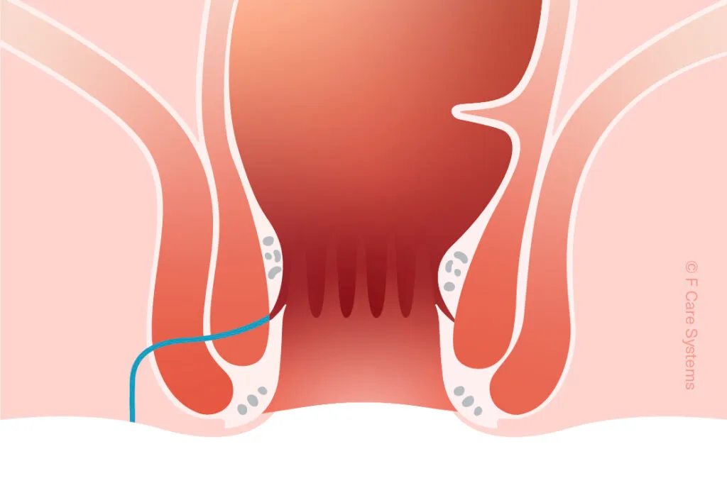 ProctoCor Treatment